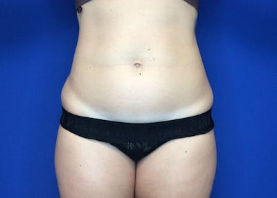 Liposuction Before & After Gallery - Patient 36586975 - Image 1