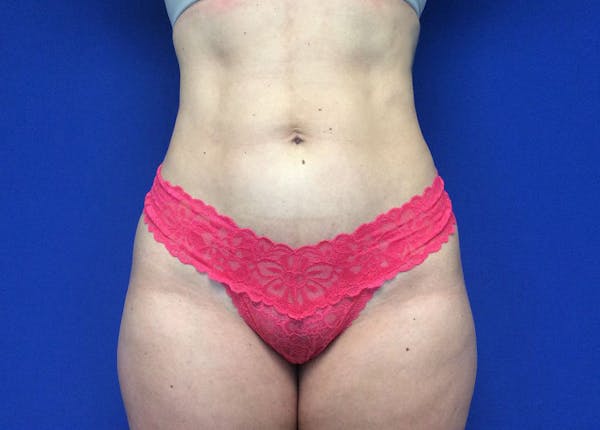 Liposuction Before & After Gallery - Patient 36586975 - Image 2