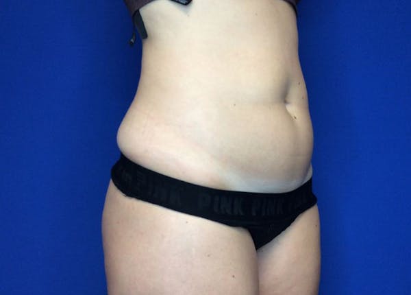 Liposuction Before & After Gallery - Patient 36586975 - Image 3