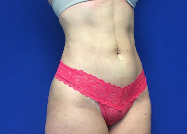Liposuction Before & After Gallery - Patient 36586975 - Image 4