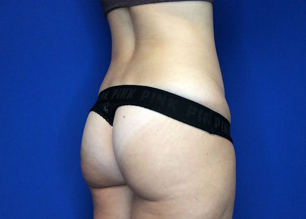 Liposuction Before & After Gallery - Patient 36586975 - Image 5