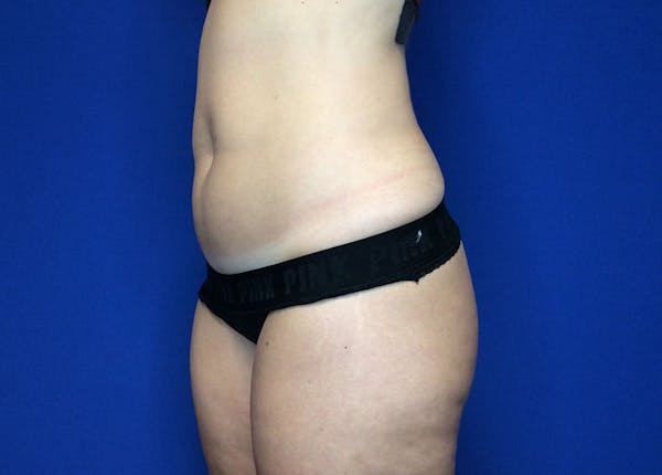 Liposuction Before & After Gallery - Patient 36586975 - Image 7