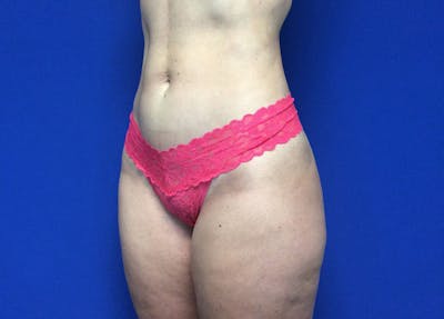 Liposuction Before & After Gallery - Patient 36586975 - Image 8