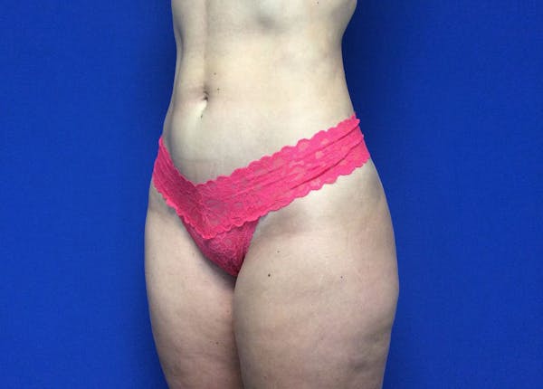 Liposuction Before & After Gallery - Patient 36586975 - Image 8