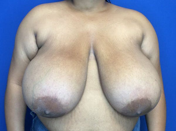 Breast Reduction Before & After Gallery - Patient 38891689 - Image 1