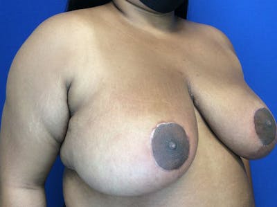 Breast Reduction Before & After Gallery - Patient 38891689 - Image 4