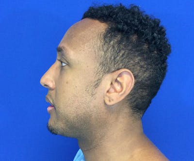 Chin Augmentation Before & After Gallery - Patient 44774202 - Image 6