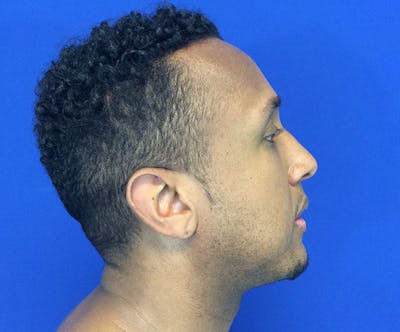 Chin Augmentation Before & After Gallery - Patient 44774202 - Image 10
