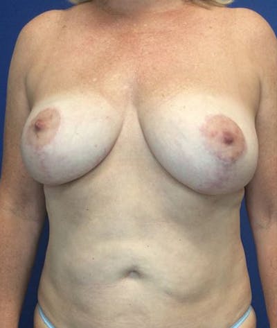 Mastopexy Before & After Gallery - Patient 4910306 - Image 2
