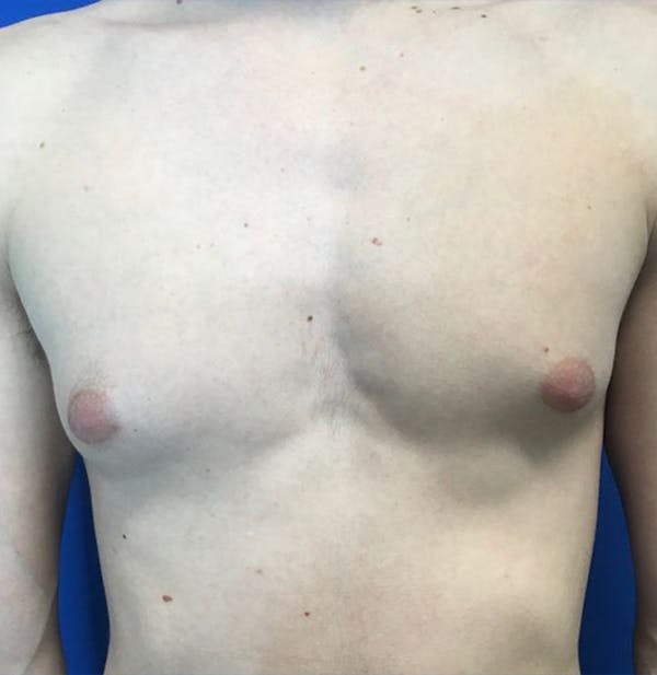 Gynecomastia Before & After Gallery - Patient 45390979 - Image 1