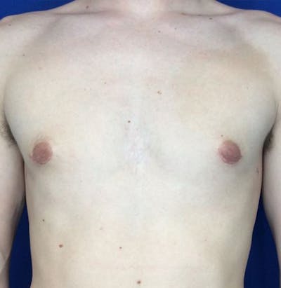 Gynecomastia Before & After Gallery - Patient 45390979 - Image 2