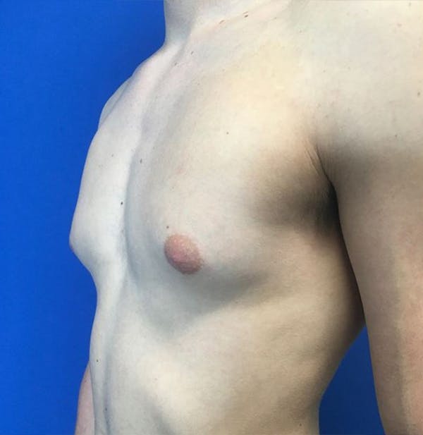 Gynecomastia Before & After Gallery - Patient 45390979 - Image 3