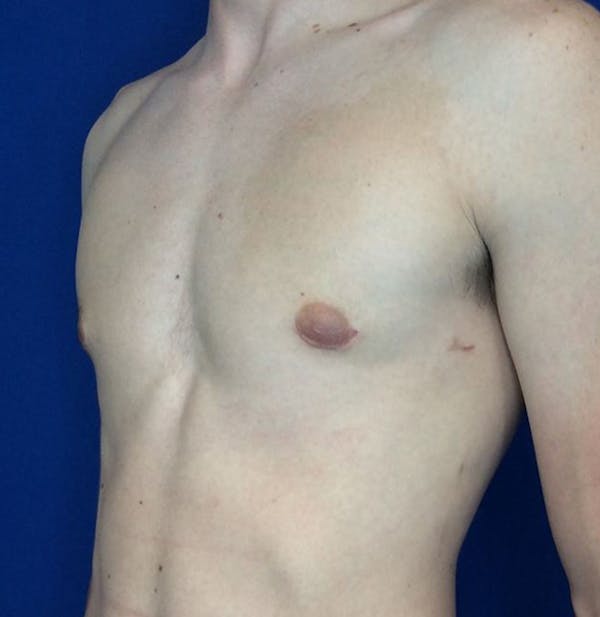 Gynecomastia Before & After Gallery - Patient 45390979 - Image 4