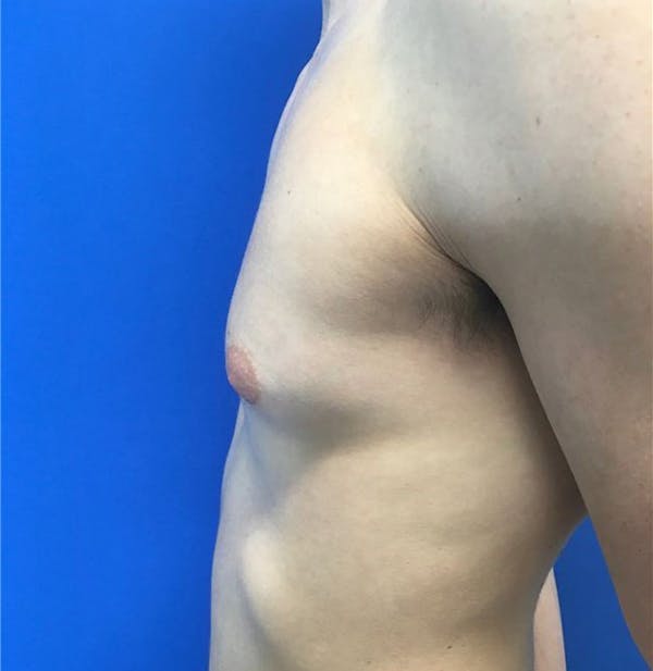 Gynecomastia Before & After Gallery - Patient 45390979 - Image 5