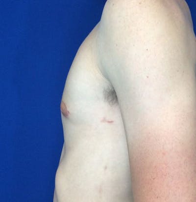 Gynecomastia Before & After Gallery - Patient 45390979 - Image 6