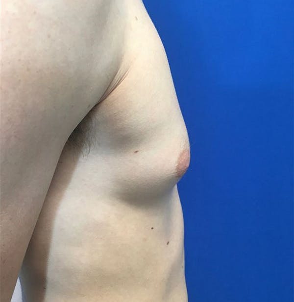 Gynecomastia Before & After Gallery - Patient 45390979 - Image 7
