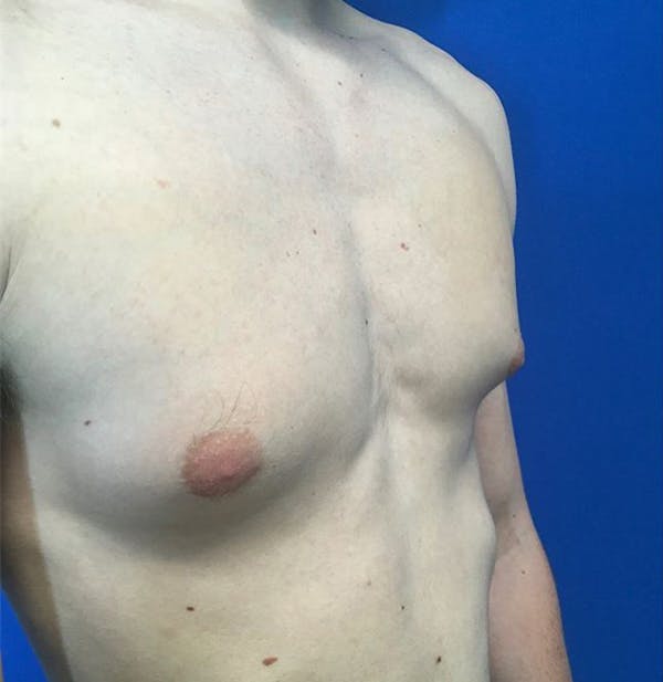 Gynecomastia Before & After Gallery - Patient 45390979 - Image 9