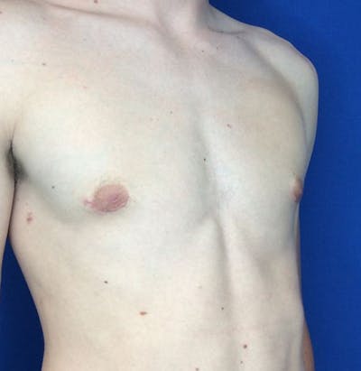Gynecomastia Before & After Gallery - Patient 45390979 - Image 10