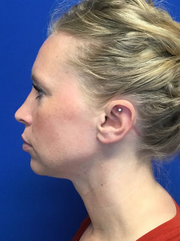 Neck Lift Before & After Gallery - Patient 46611418 - Image 2