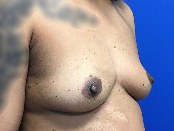 Breast Augmentation Before & After Gallery - Patient 47122206 - Image 3