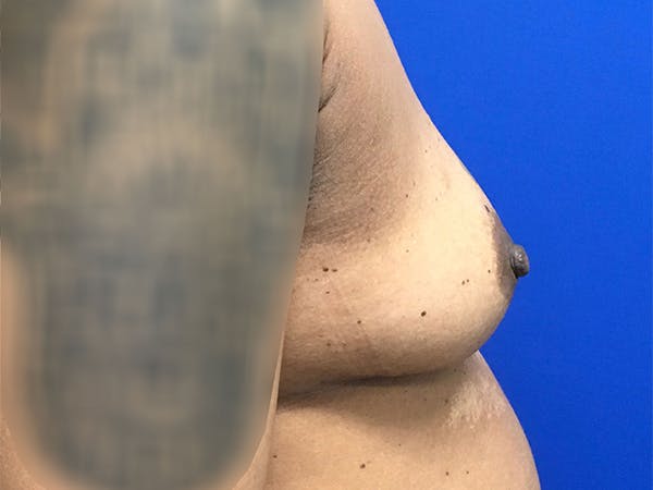 Breast Augmentation Before & After Gallery - Patient 47122206 - Image 5