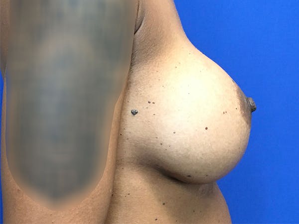 Breast Augmentation Gallery - Patient 47122206 - Image 6