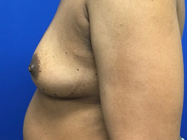 Breast Augmentation Before & After Gallery - Patient 47122206 - Image 7