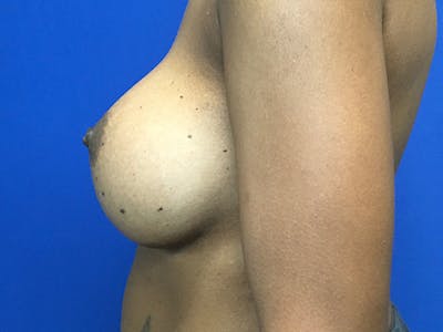 Breast Augmentation Before & After Gallery - Patient 47122206 - Image 8