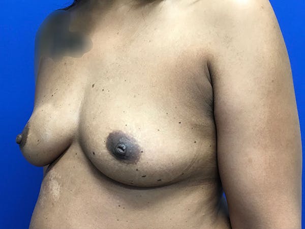 Breast Augmentation Before & After Gallery - Patient 47122206 - Image 9