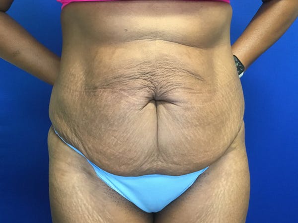 Tummy Tuck (Abdominoplasty) Before & After Gallery - Patient 47914639 - Image 1