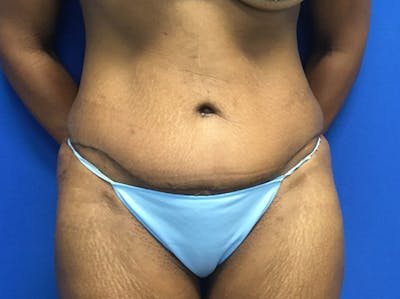 Tummy Tuck (Abdominoplasty) Before & After Gallery - Patient 47914639 - Image 2