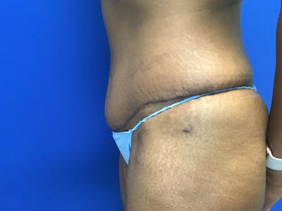 Tummy Tuck (Abdominoplasty) Gallery - Patient 47914639 - Image 4