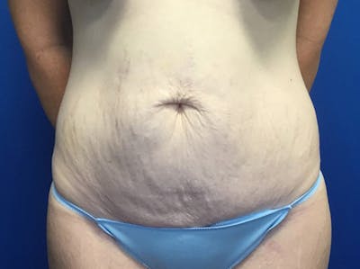 Tummy Tuck (Abdominoplasty) Before & After Gallery - Patient 48077065 - Image 1