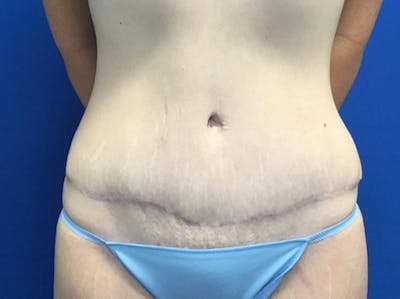 Tummy Tuck (Abdominoplasty) Gallery - Patient 48077065 - Image 2