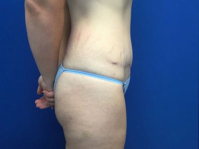 Tummy Tuck (Abdominoplasty) Before & After Gallery - Patient 48077065 - Image 4