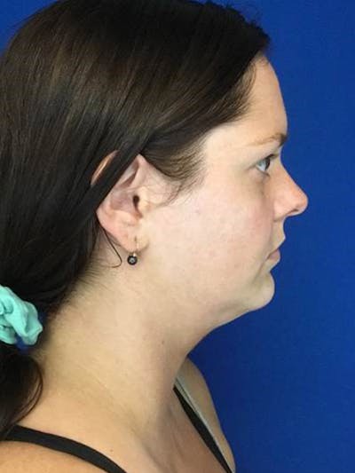 Neck Lift Before & After Gallery - Patient 50311800 - Image 1