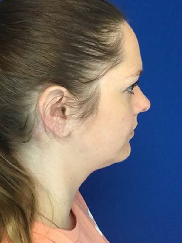 Neck Lift Before & After Gallery - Patient 50311800 - Image 2