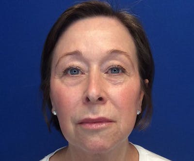 Thread Lift Before & After Gallery - Patient 50993323 - Image 2