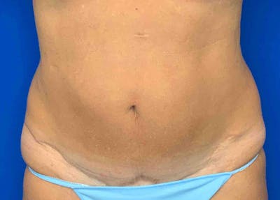 Liposuction Before & After Gallery - Patient 51852703 - Image 1