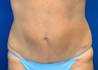 Liposuction Before & After Gallery - Patient 51852703 - Image 2