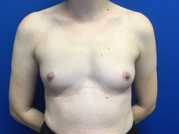 Breast Augmentation Gallery - Patient 55027763 - Image 1