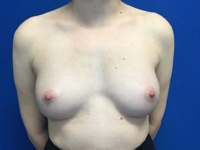 Breast Augmentation Before & After Gallery - Patient 55027763 - Image 2