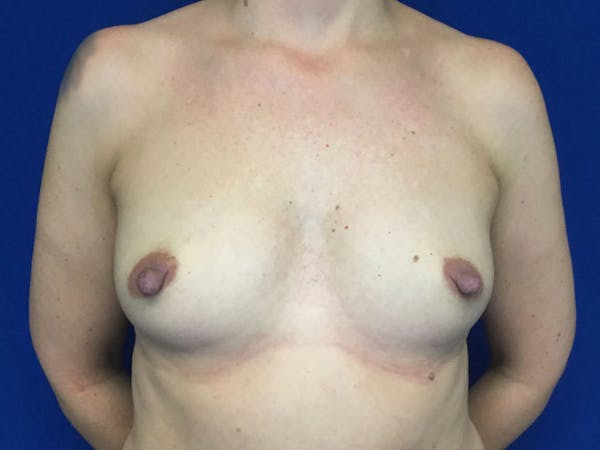 Breast Augmentation Before & After Gallery - Patient 55042614 - Image 1