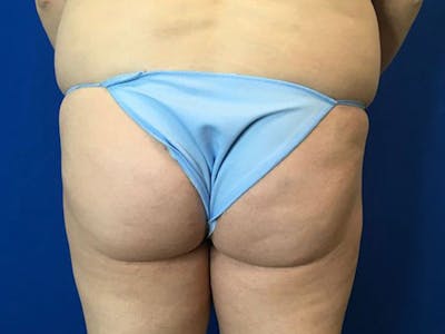 Brazilian Butt Lift Before & After Gallery - Patient 55042893 - Image 1