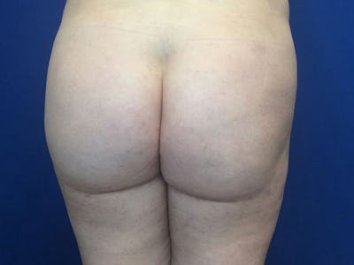 Brazilian Butt Lift Before & After Gallery - Patient 55042893 - Image 2