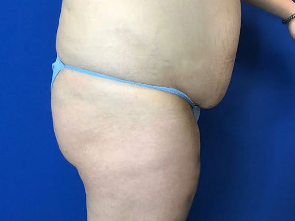 Brazilian Butt Lift Before & After Gallery - Patient 55042893 - Image 3