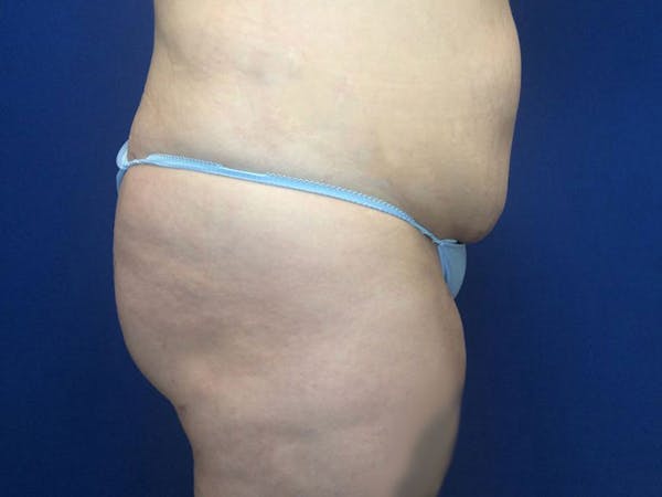 Brazilian Butt Lift Before & After Gallery - Patient 55042893 - Image 4