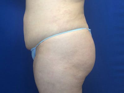 Brazilian Butt Lift Before & After Gallery - Patient 55042893 - Image 6