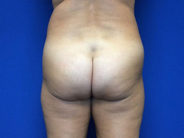 Brazilian Butt Lift Before & After Gallery - Patient 55042894 - Image 1