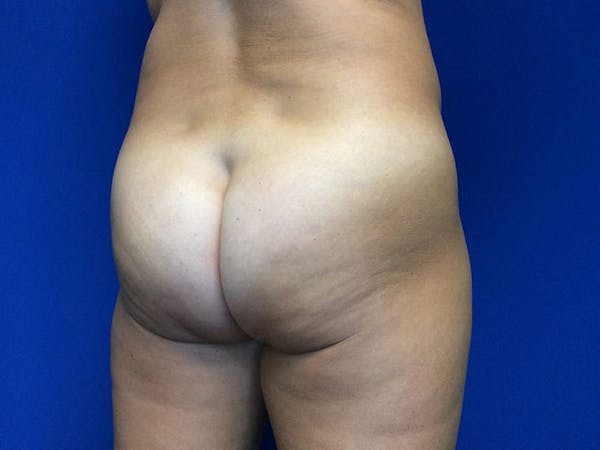 Brazilian Butt Lift Before & After Gallery - Patient 55042894 - Image 7